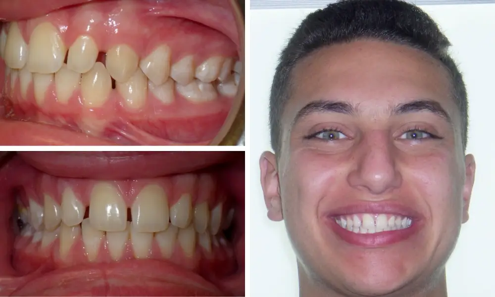 Importance Of Properly Aligned/Straight Teeth