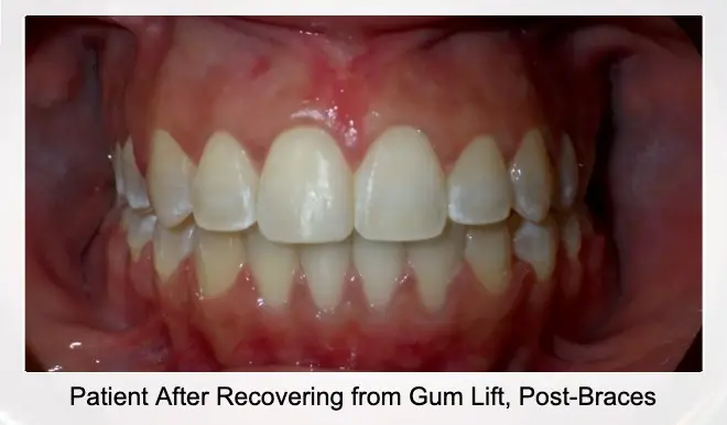 Patient After Recovering from Gum Lift