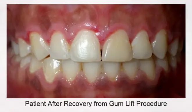 Patient After Recovery From Gum Lift