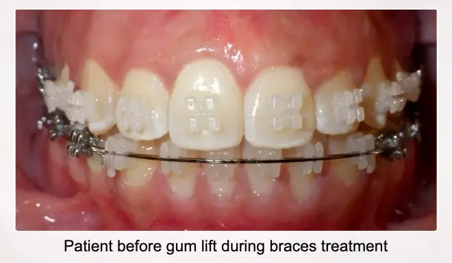 Patient Before Gum Lift During Braces Treatment