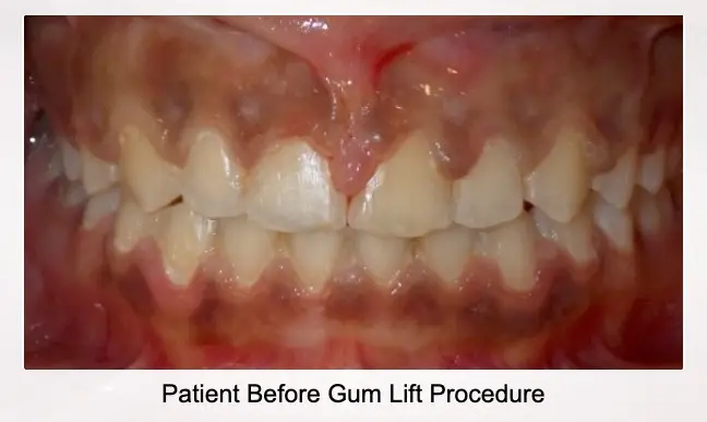 Patient Before Gum Lift Procedure