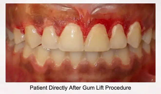 Patient Directly After Gum Lift Procedure
