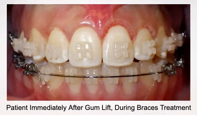 Patient Immediately After Gum Lift