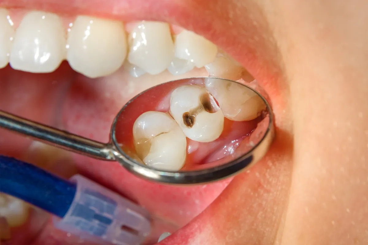 Preocupado por cómo una caries puede afectar su elegibilidad para el tratamiento con Invisalign