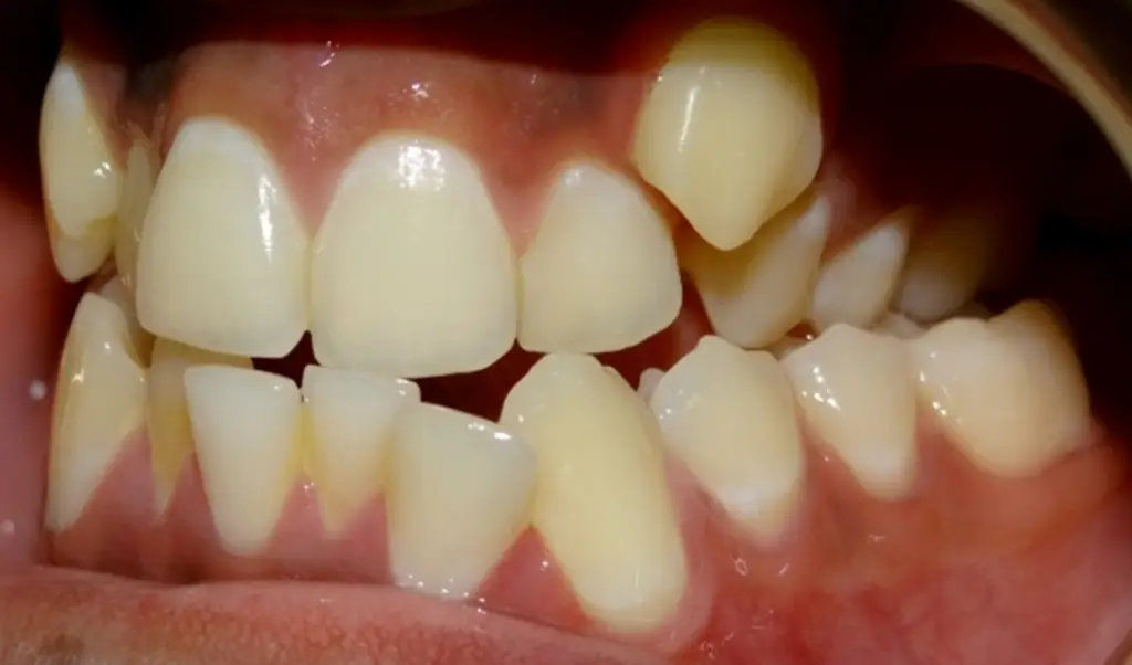 Posterior Crossbite