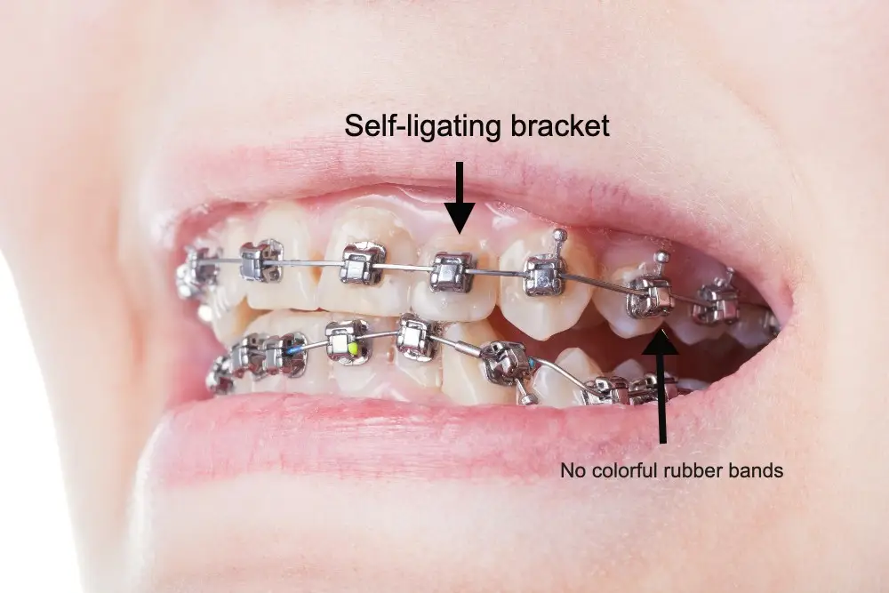 How Much Do Lingual Braces Cost in CT?