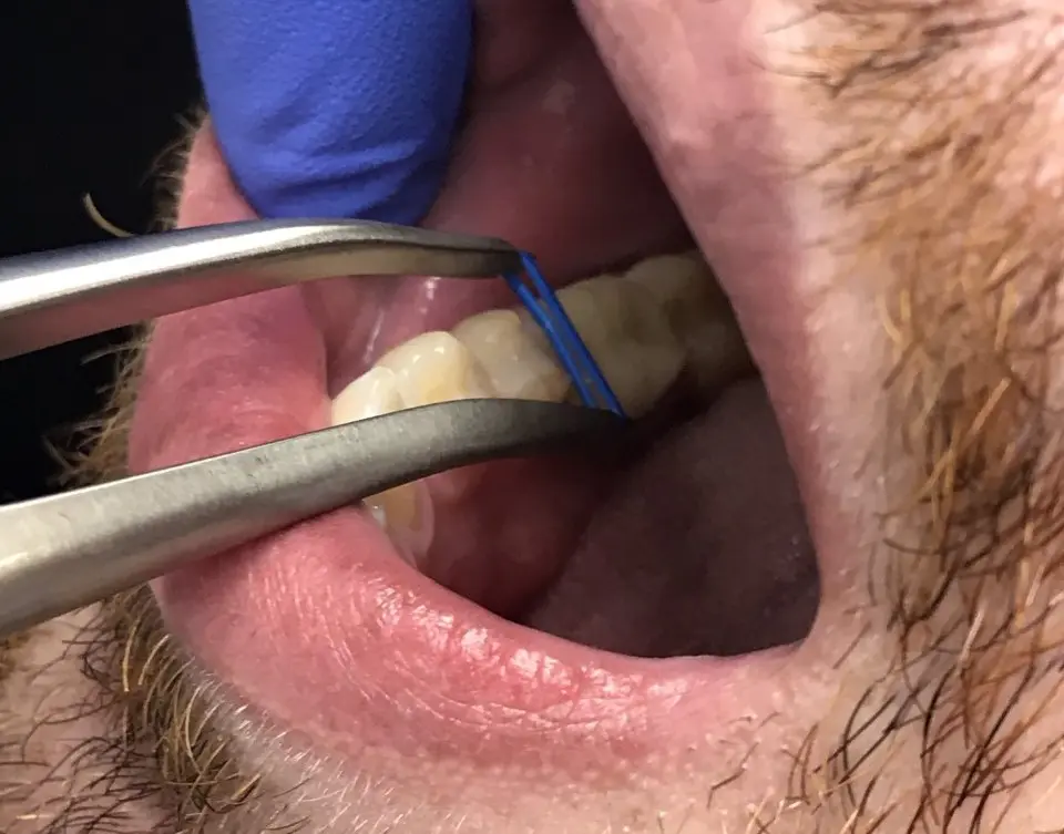 Spacers being installed between teeth before braces