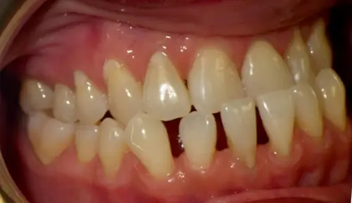 Spaces caused by gum recession and traumatic bite
