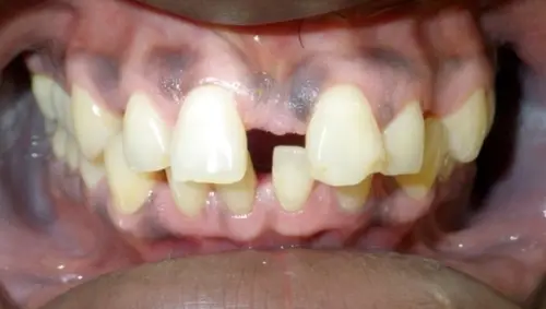 Spaces caused by large frenum and small teeth