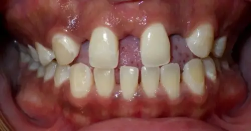 Spaces caused by missing teeth