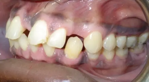 Spaces caused by small teeth and deep overbite