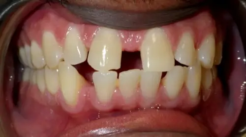 Spaces caused by small teeth and frenum