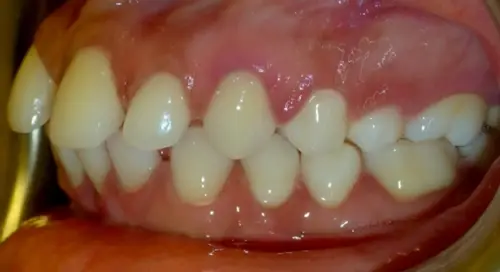 Espacios causados por dientes pequeños