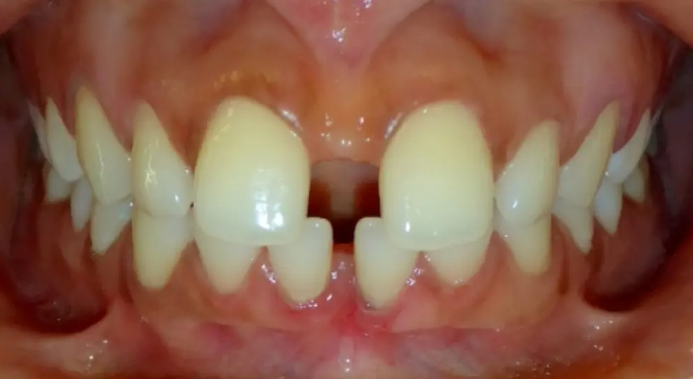 Spaces gaps between teeth