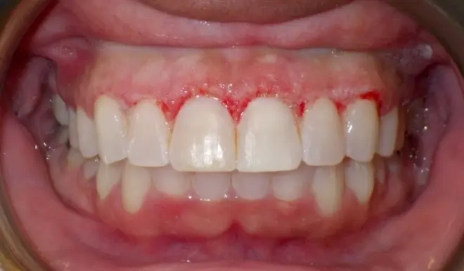 after gingivectomy