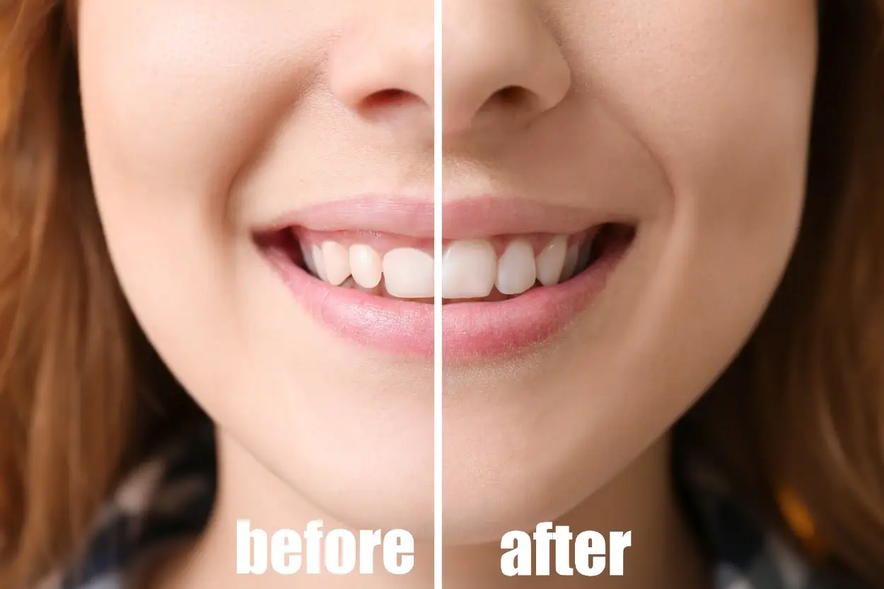 antes y después de la gingivectomía