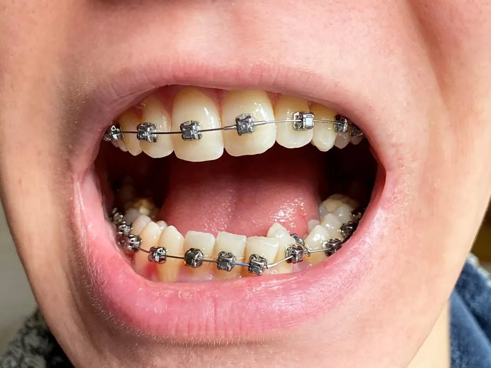 braces patient with open bite