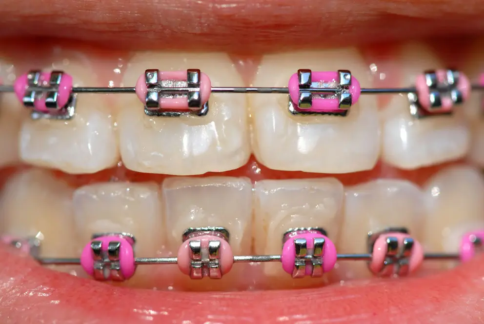 braces pros and cons