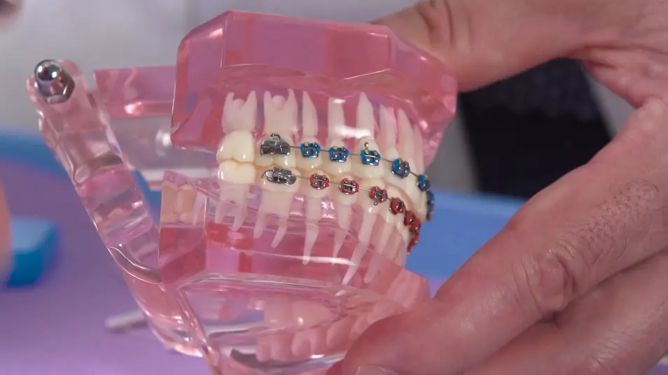 video : Orthodontic Emergencies: What to Know and What to Do