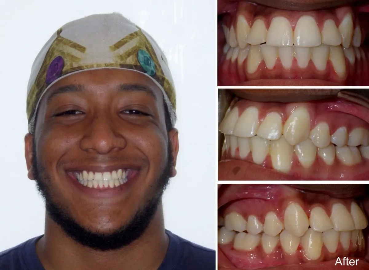 carlos  years old front and back crossbite after treatment with braces