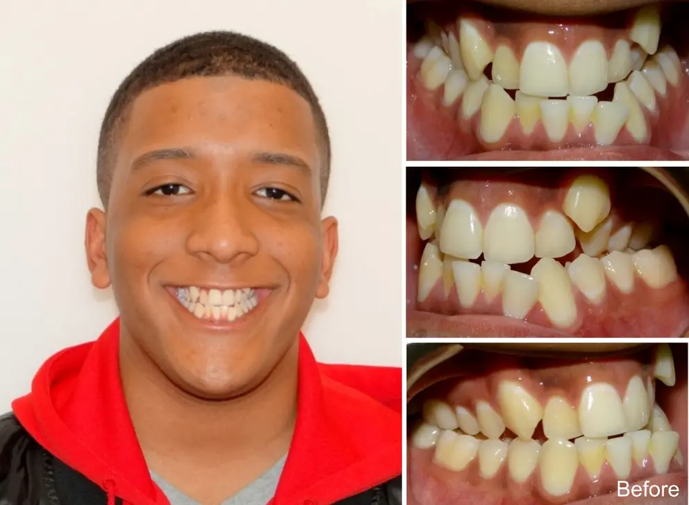 carlos  years old front and back crossbite before treatment with braces