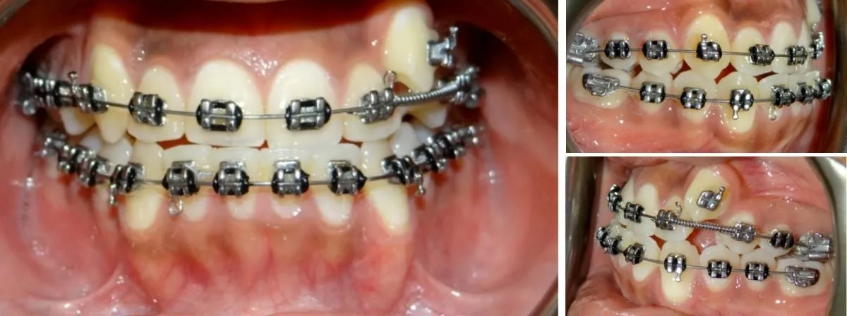 carlos  years old front and back crossbite braces placed