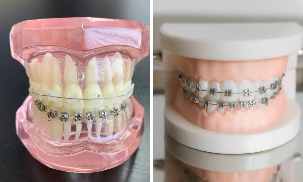 video Ceramic Braces vs Metal Braces Cost, Pros & Cons, Pictures, FAQs