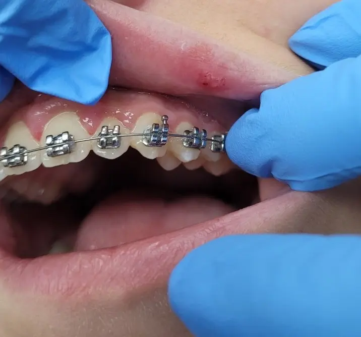 diamondbraces patient sores ulcers from braces