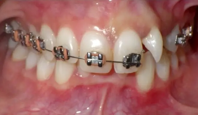 diamondbraces patient with broken braces arch wire e