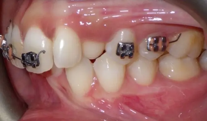 What to do when I have an orthodontic wire sticking out and poking the gums?