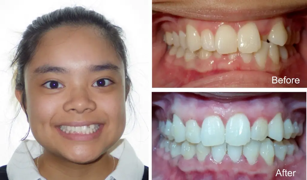 elizabeth  yo with crossbite before and after Invisalign treatment