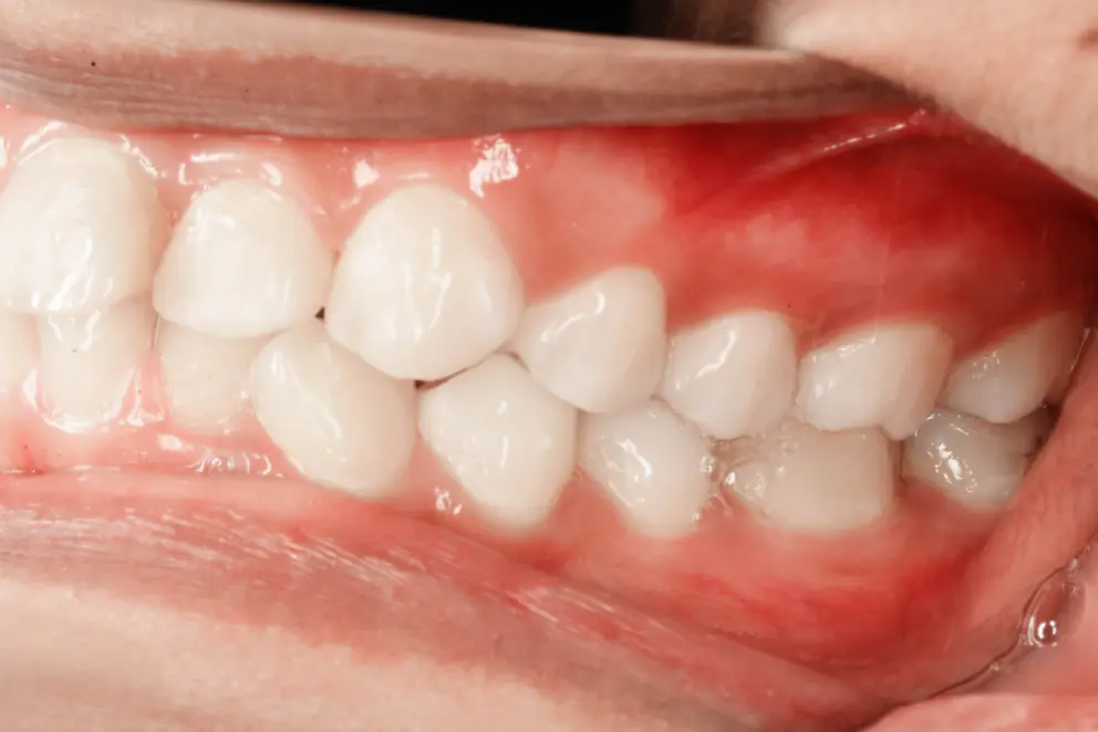 example of gum disease