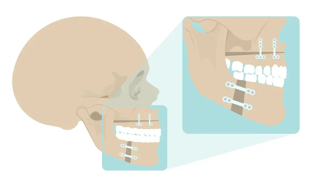 example of orthognathic surgery