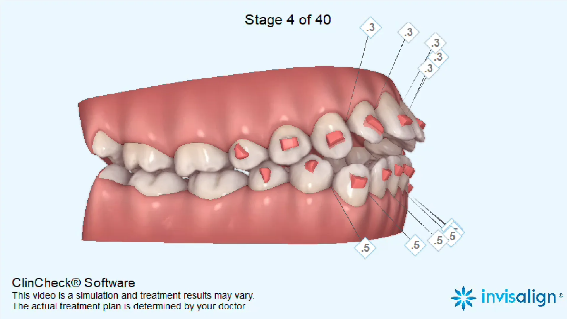 5 Stages in Invisalign Treatment