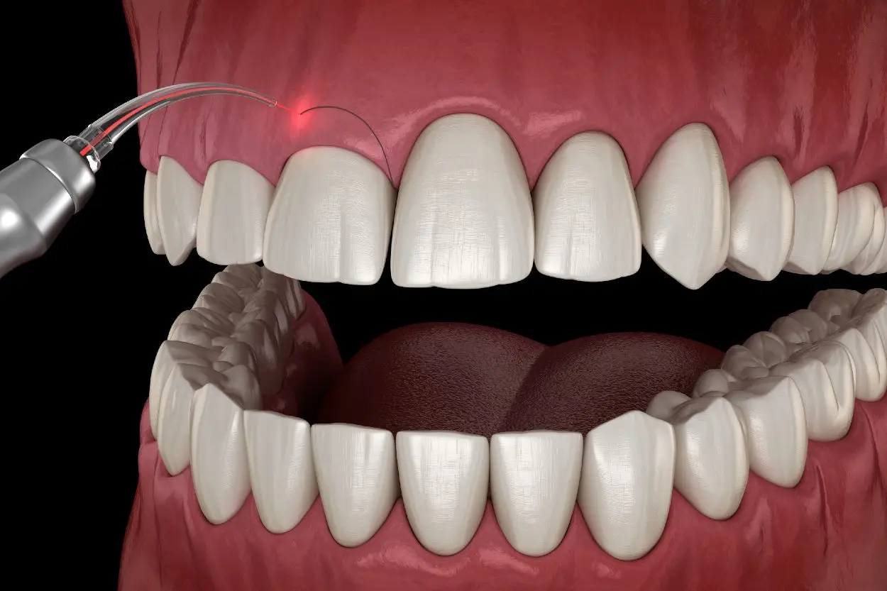gingivectomy with laser