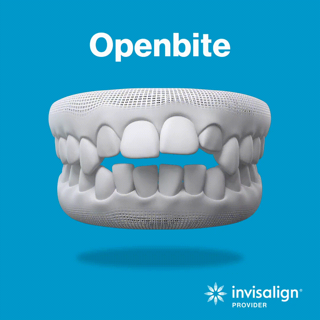 Affordable Open Bite Solutions Braces, Invisalign, Surgery, and Retainers