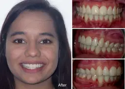 jugdeep  years old overjet and overbite after invisalign treatment