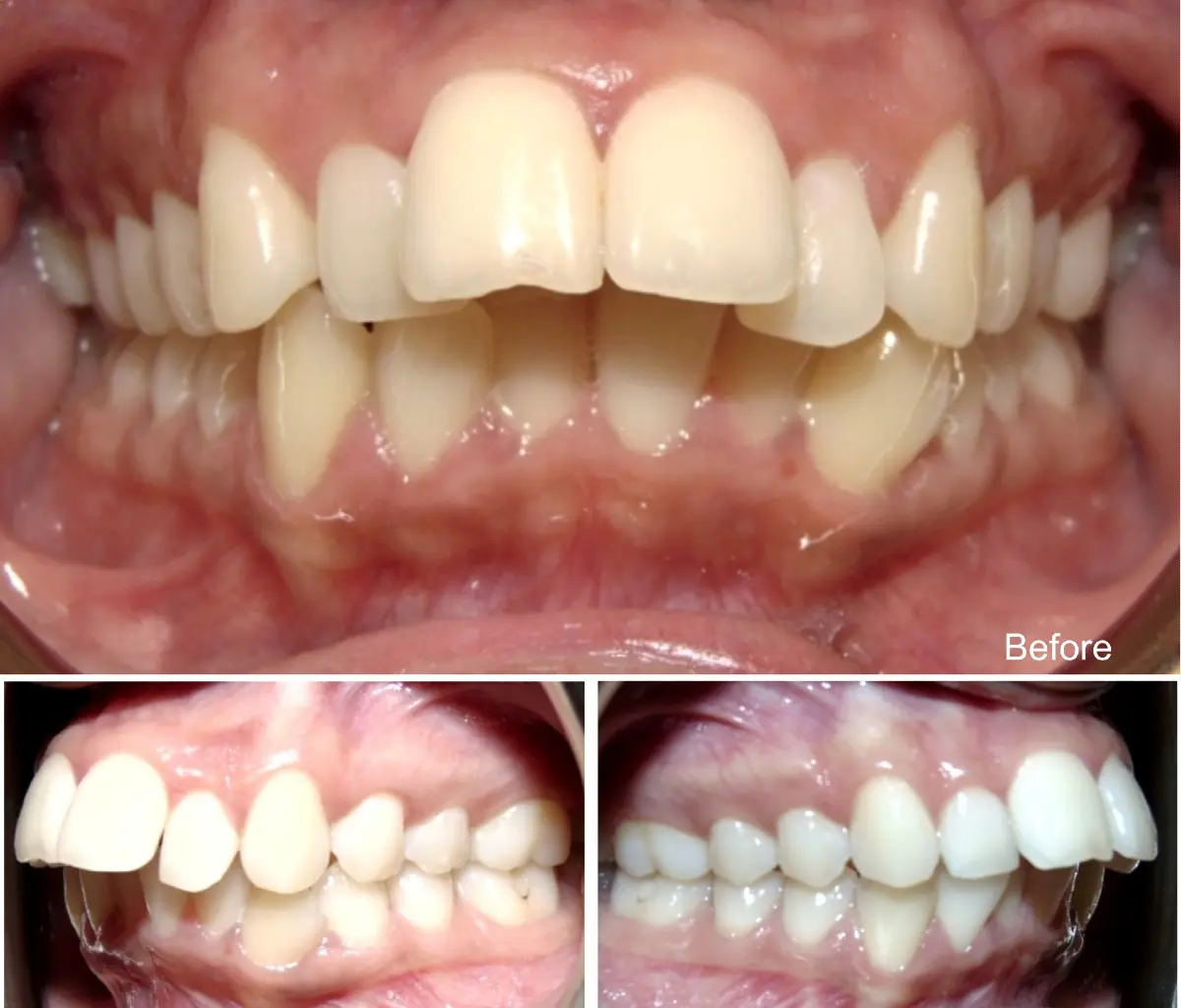 Jugdeep  años con exceso de sobremordida y sobremordida antes del tratamiento Invisalign