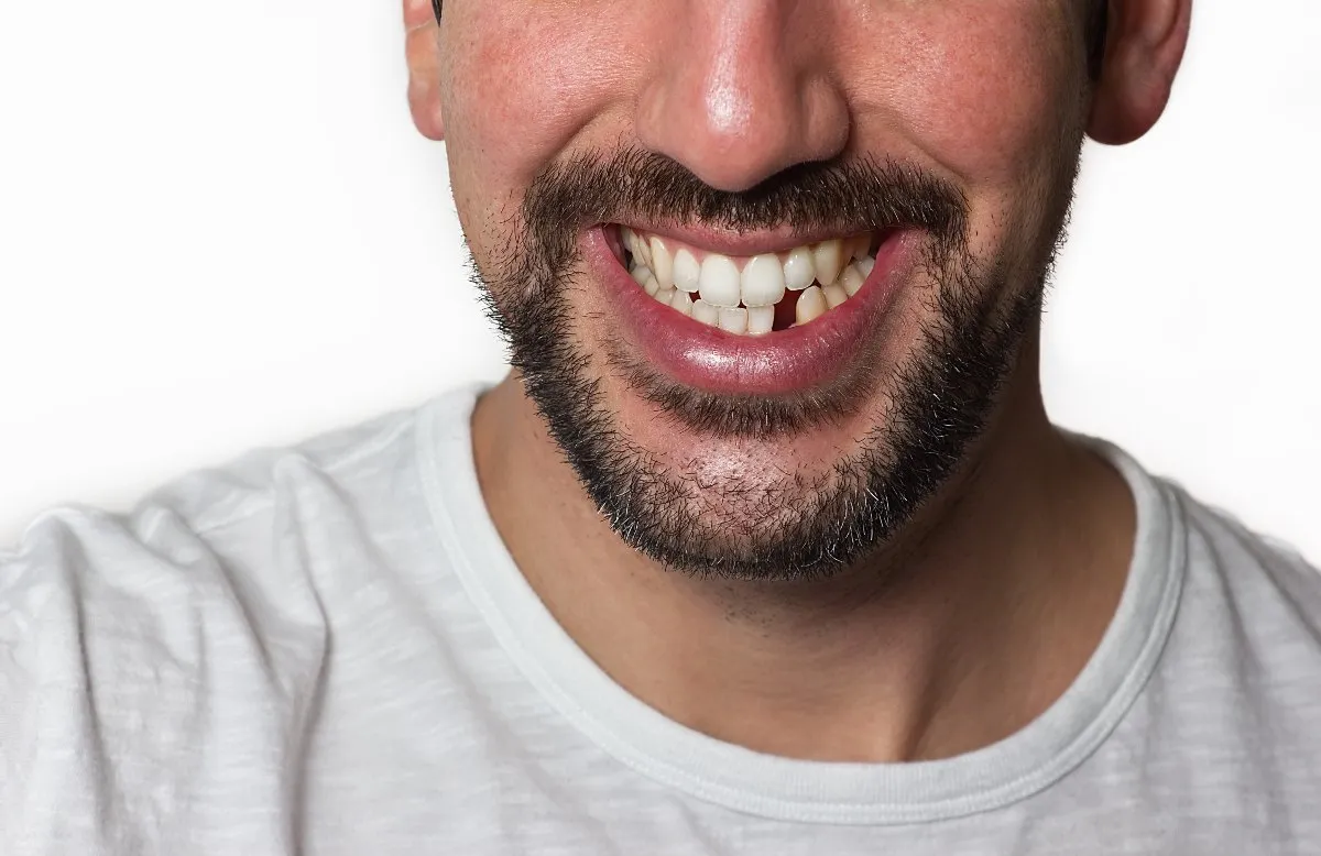 man with missing tooth wearing invisalign
