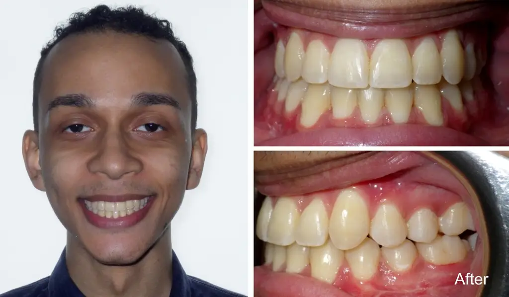 manuel  years old crossbite sugical correction after treatment