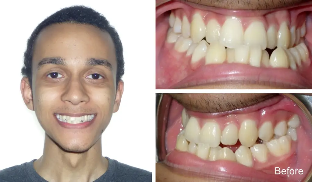 manuel  years old crossbite sugicalcorrection before treatment