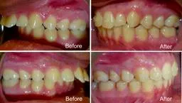 mark  years old overjet correction with invisalign  months treatment before and after