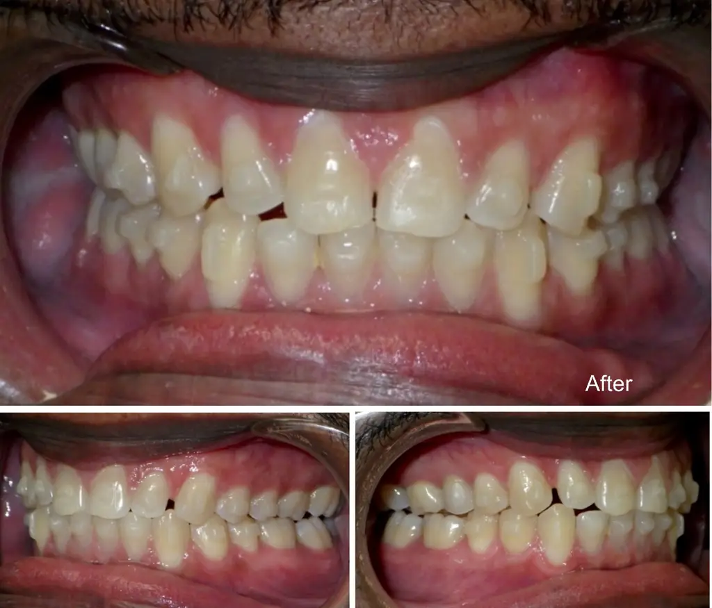 nigel  years small teeth spaces closure after Invisalign treatment