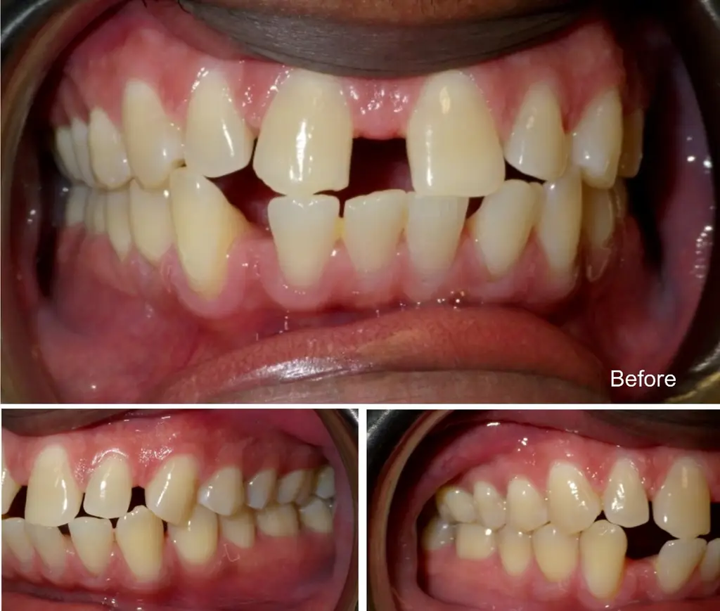 Nigel 35 años, espacios pequeños entre los dientes, antes del tratamiento con Invisalign