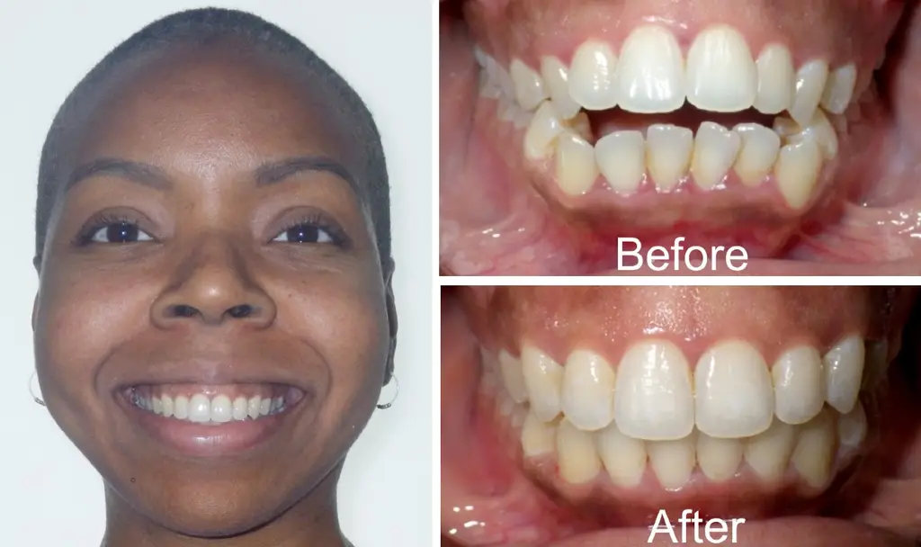 open bite before and after invisalign treatment  years old female front view