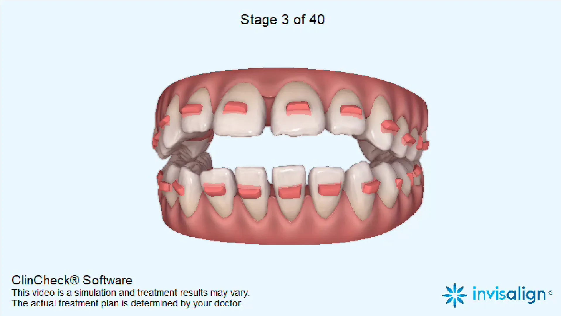 Can invisalign fix open bite? - Exploring Solutions