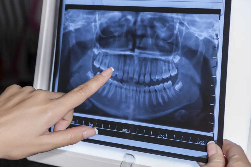 WHAT ARE   Digital Dental X-Rays
