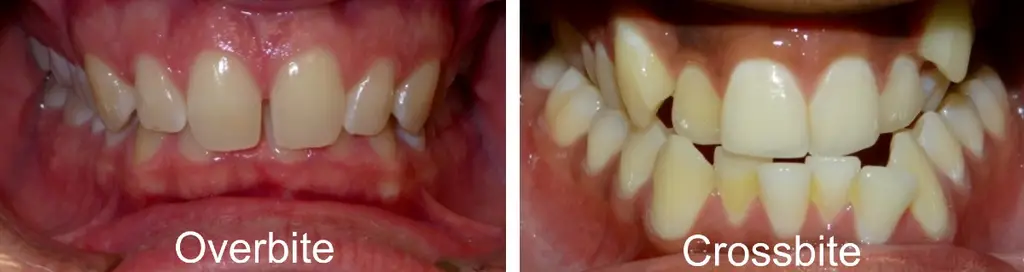 What is Overbite: Symptoms, Diagnosis and Treatment