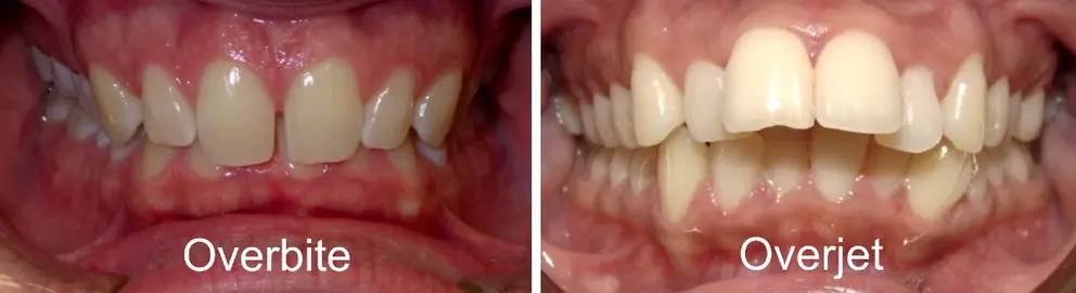 overbite vs verjet