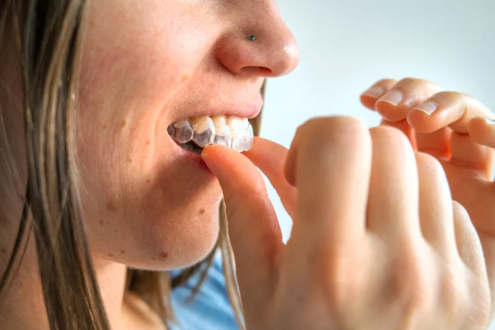 Can Clear Aligners Improve Periodontal Health